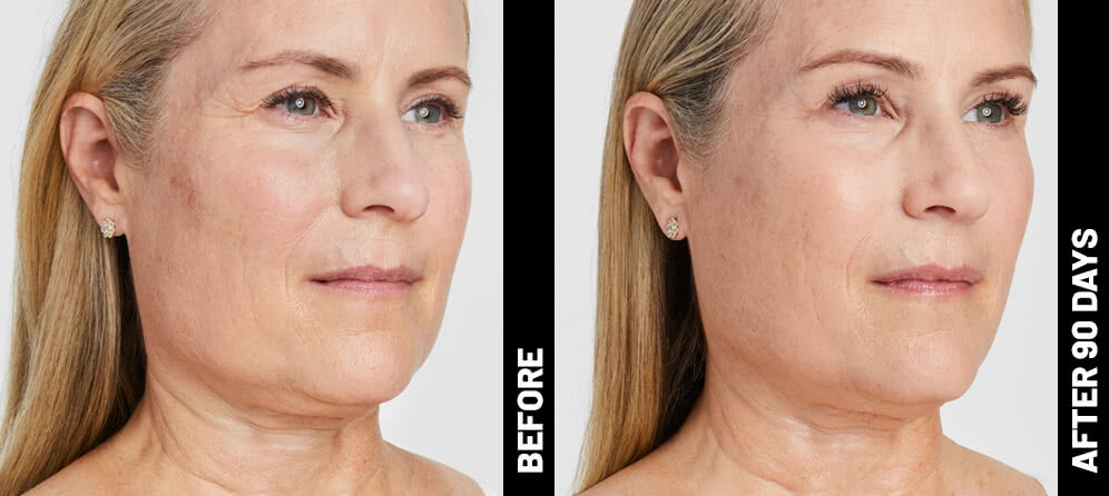Before & After | Brow, Neck, Upper Chest & Chin Lift | Ultherapy