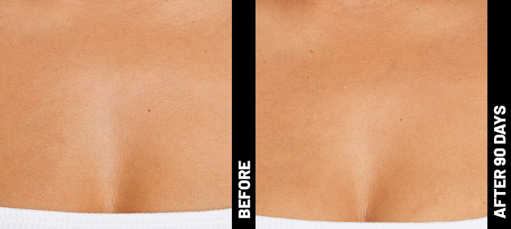 erin, decolletage results after 90 days