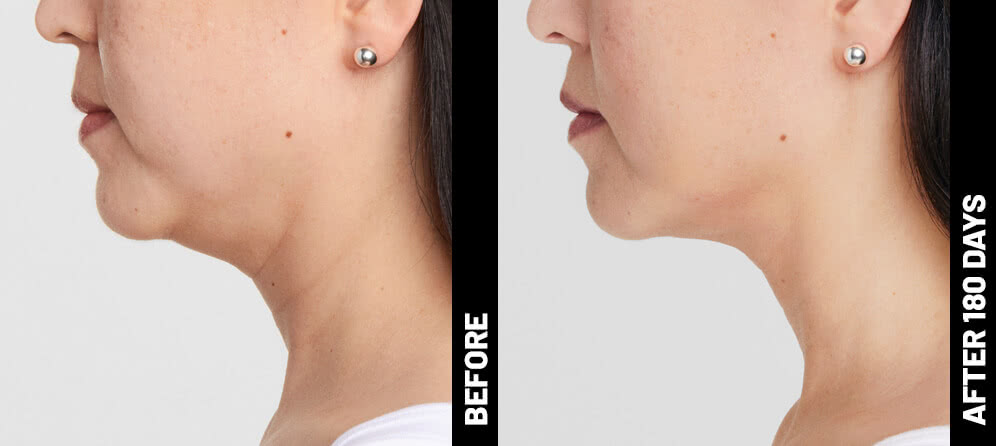 grace, profile results after 180 days