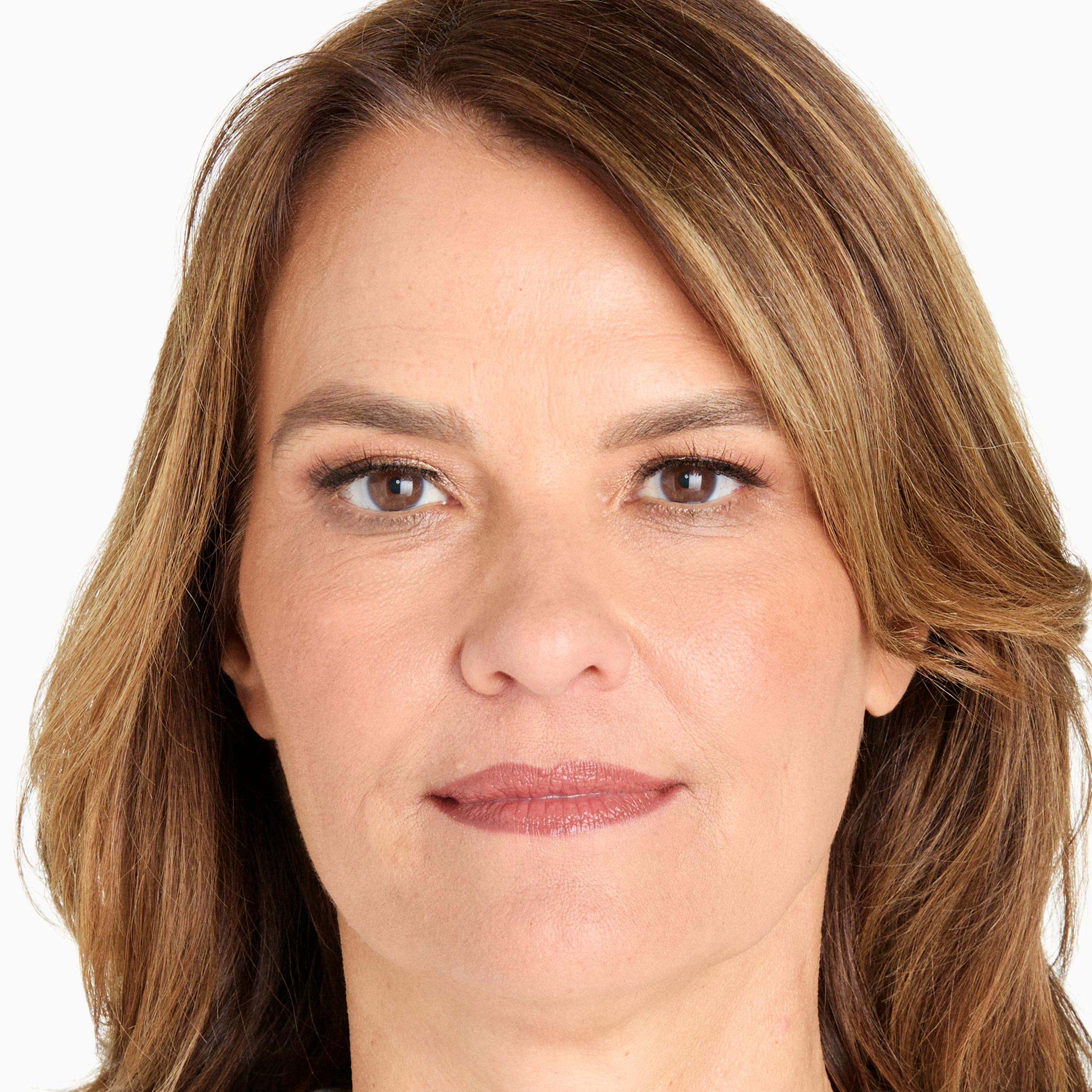 Results after 90 days of Ultherapy skin tightening treatment