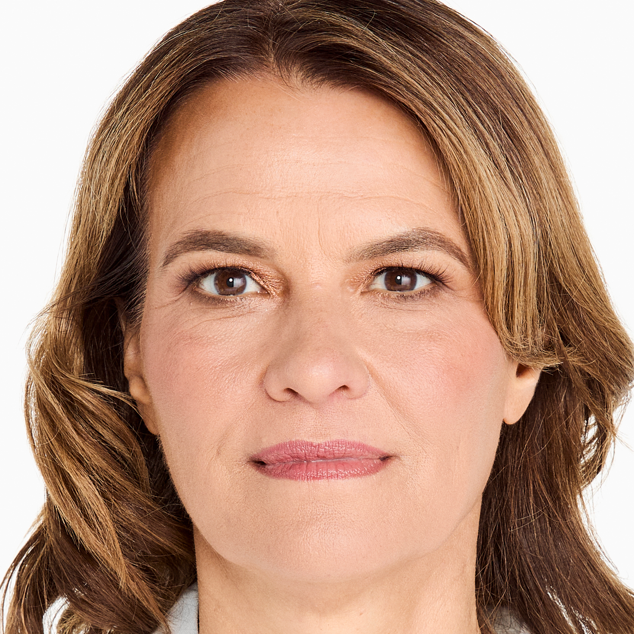 Before photo highlighting areas for Ultherapy treatment for lifting and collagen production.