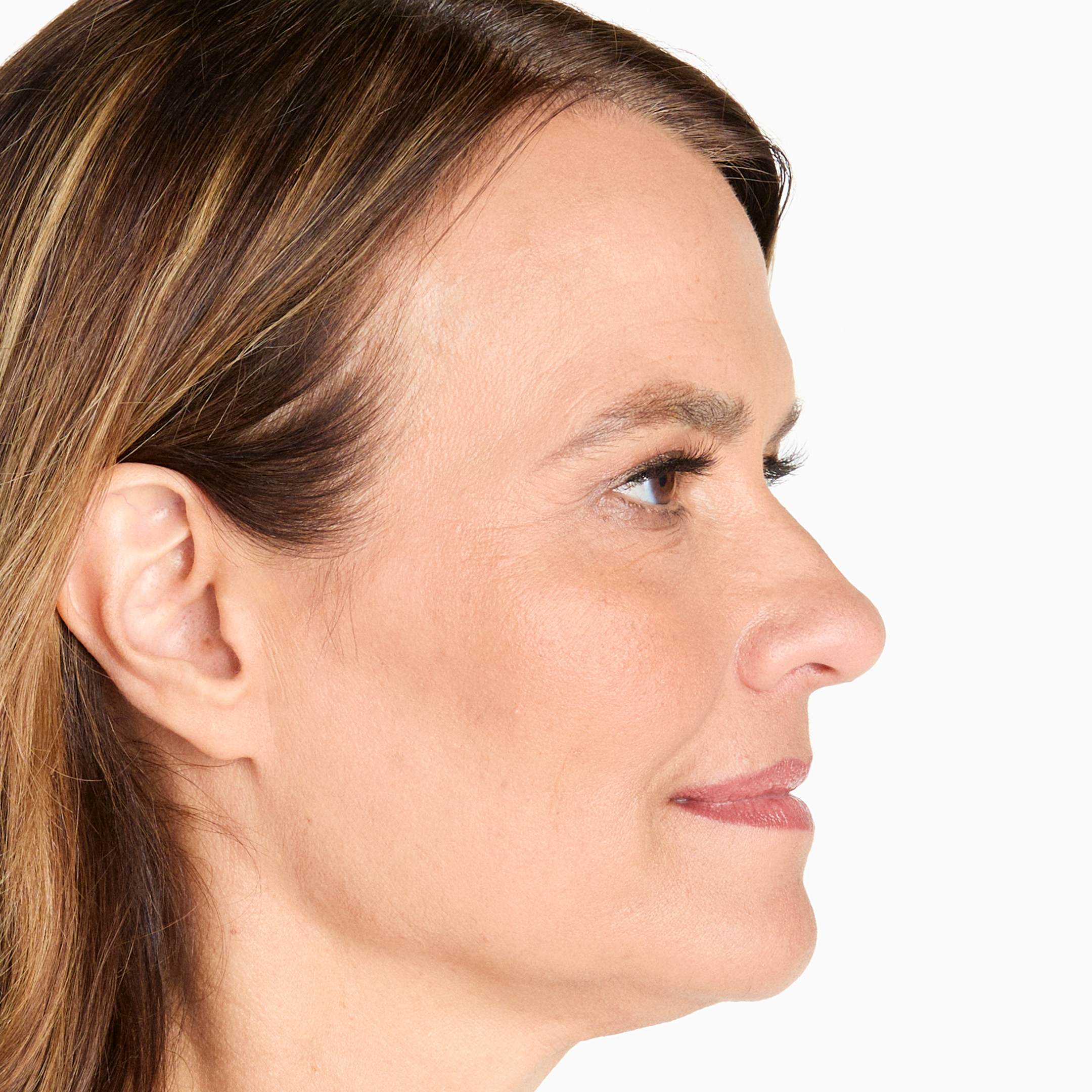 Results after 90 days of Ultherapy skin tightening treatment