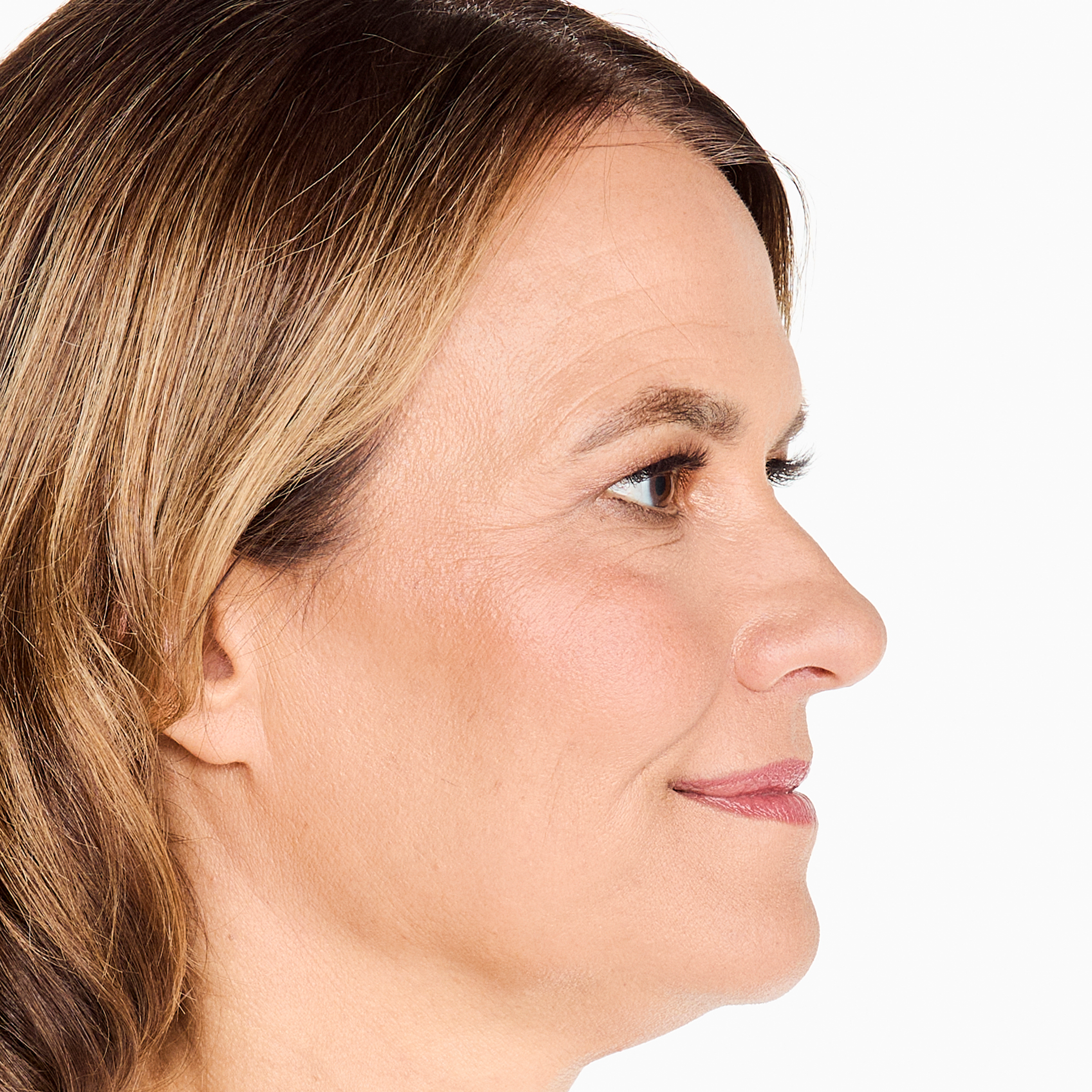 Before photo highlighting areas for Ultherapy treatment for lifting and collagen production.