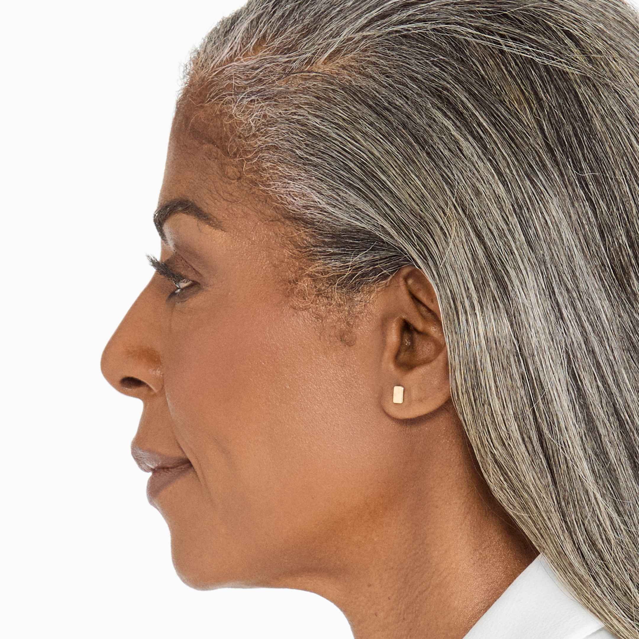 Results after 180 days of Ultherapy skin tightening treatment