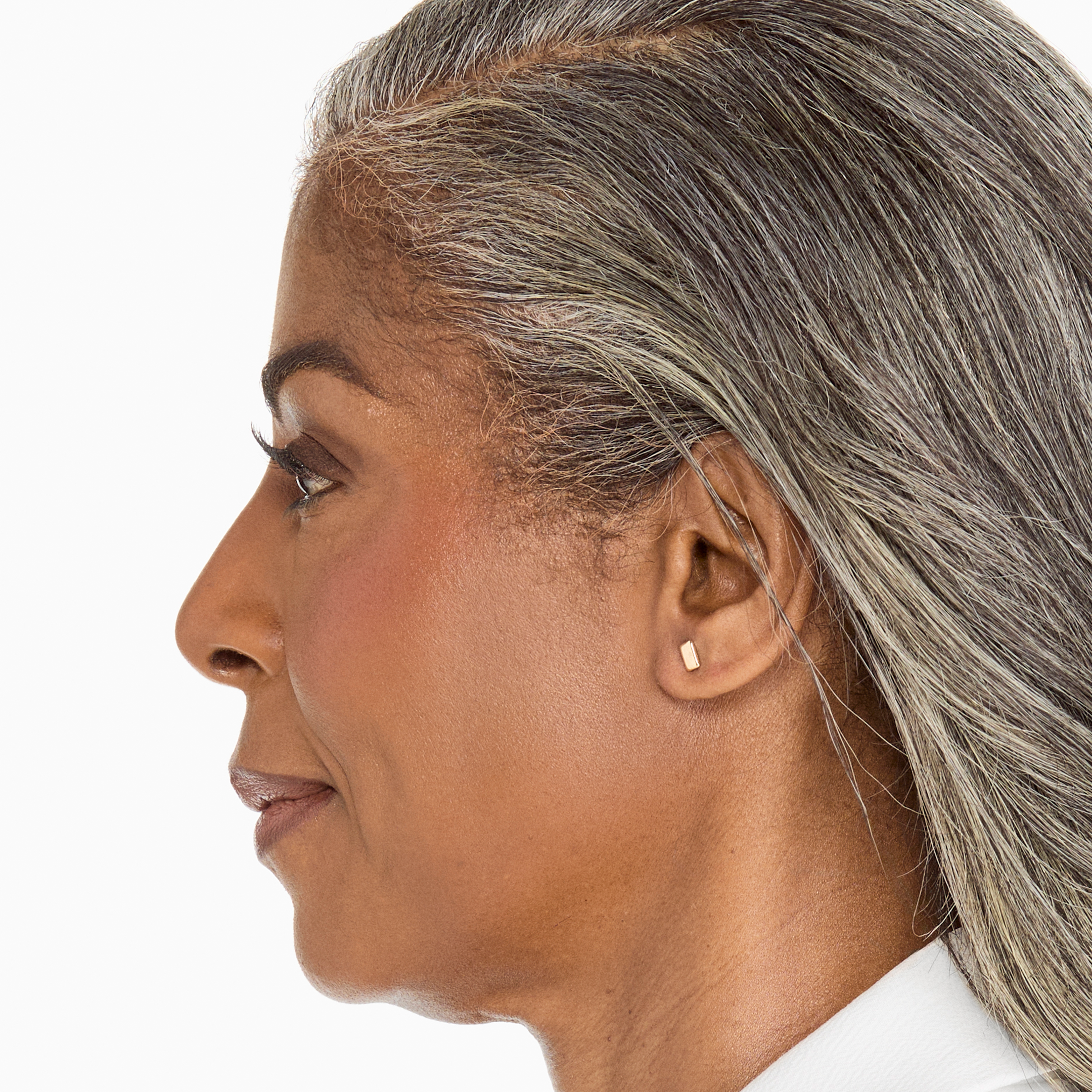 Before photo highlighting areas for Ultherapy treatment for lifting and collagen production.