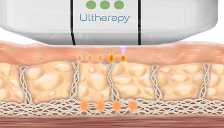 Animation of How Ultherapy Stimulates Collagen Production at Different Layers Skin Tightening