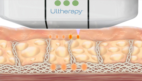 Ultherapy Tarpon Springs