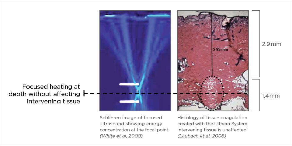 Depth Of Ultherapy Treatment