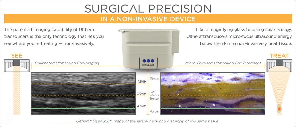 Imaging of Ultherapy Treatment