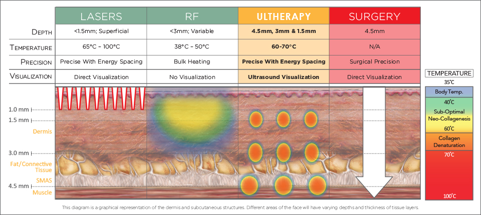 four key factors of Ultherapy