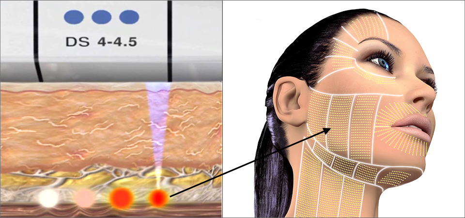 Ultherapy creates micro-coagulation points at 3 depths below the skin's surface