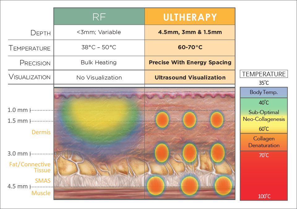 unique-technology-RF-Ultherapy
