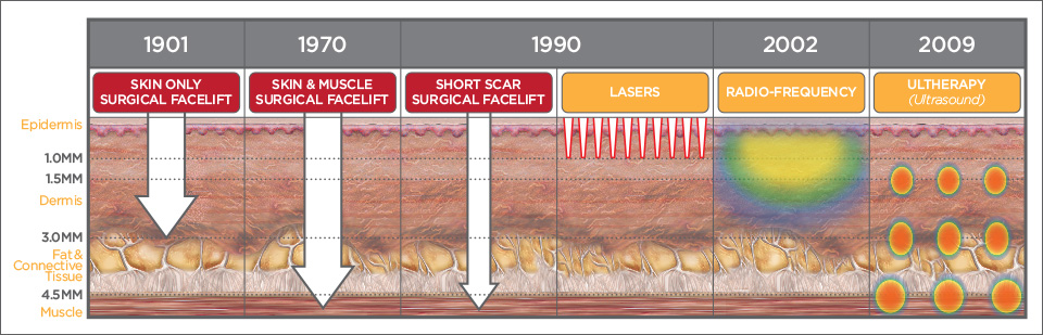 FDA-clearance for non-invasive browlift