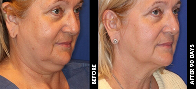 Side-by-side before and after images showing skin lifting and tightening results post-Ultherapy. 