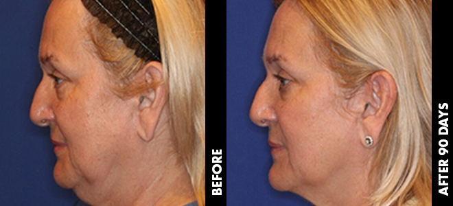 Side-by-side before and after images showing skin lifting and tightening results post-Ultherapy. 