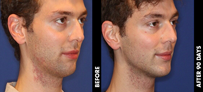Side-by-side before and after images showing skin lifting and tightening results post-Ultherapy. 