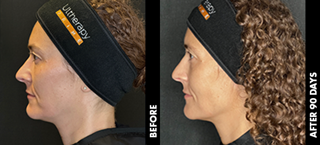 Side-by-side before and after images showing skin lifting and tightening results post-Ultherapy. 