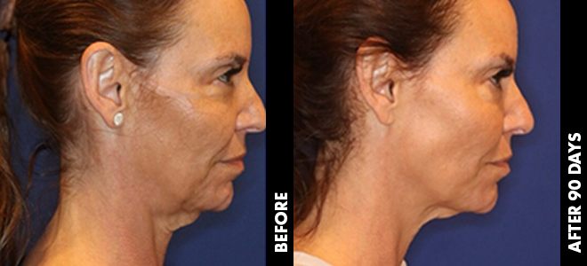 Side-by-side before and after images showing skin lifting and tightening results post-Ultherapy. 