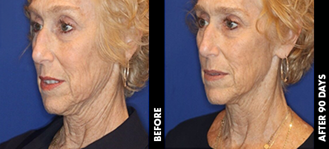 Side-by-side before and after images showing skin lifting and tightening results post-Ultherapy. 