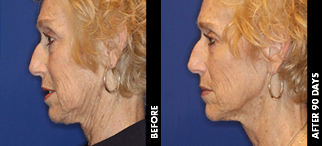 Side-by-side before and after images showing skin lifting and tightening results post-Ultherapy. 