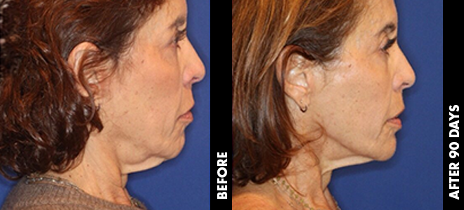 Side-by-side before and after images showing skin lifting and tightening results post-Ultherapy. 