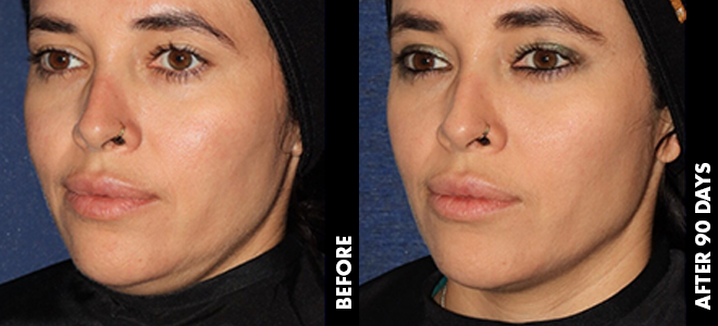 Side-by-side before and after images showing skin lifting and tightening results post-Ultherapy. 