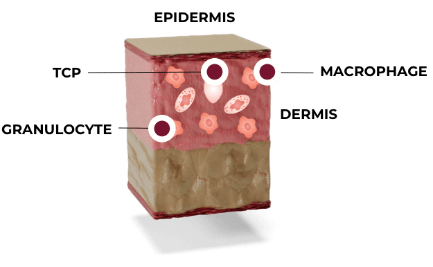 Illustration: Skin phase 1: inflamation