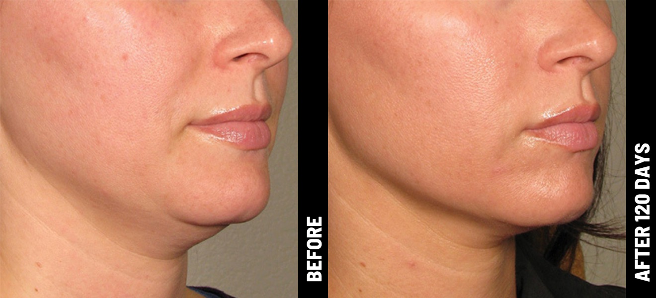 Ultherapy under-chin results